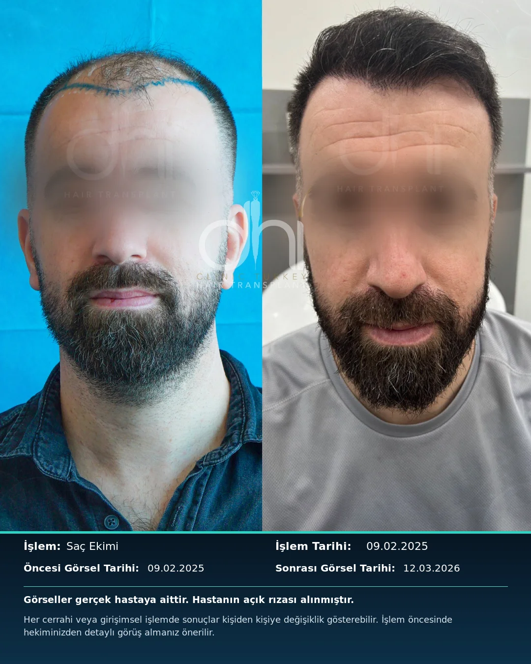 DHI Clinic Turkey hair transplant before and after result