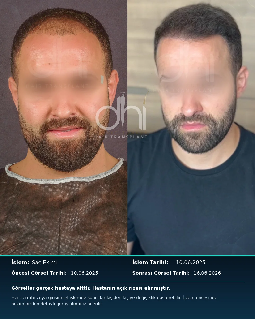 DHI Clinic Turkey hair transplant before and after result