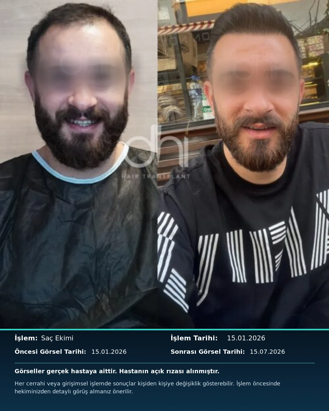 DHI Clinic Turkey hair transplant before and after result