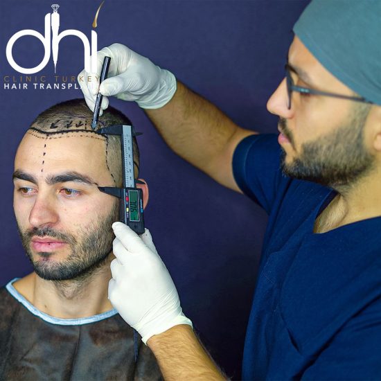 dhi-hair-transplant