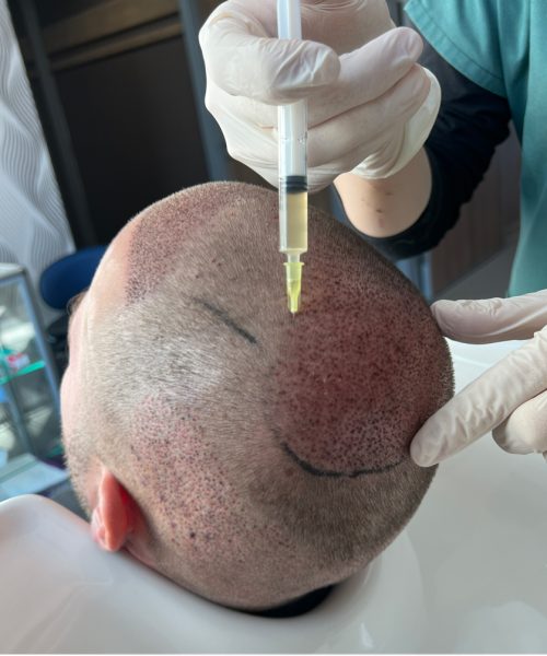 prp-hair-treatment-dhi-clinic-turkey prp-hair-treatment-dhi-clinic-turkey