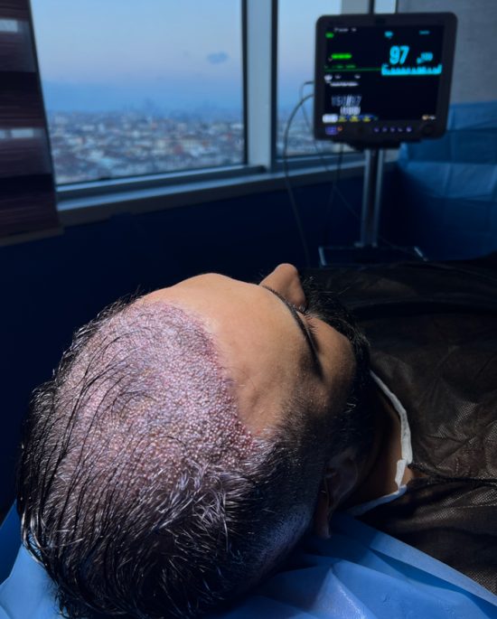 unshaven-hair-transplant-in-turkey unshaven-hair-transplant-in-turkey